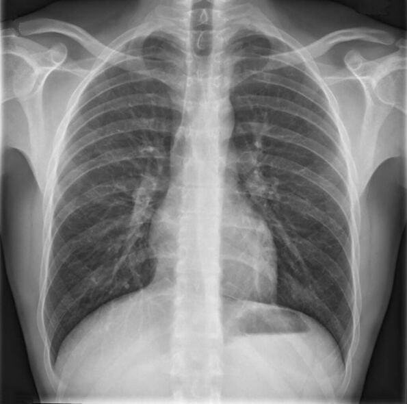 Osteochondróza hrudní páteře je diagnostikována pomocí radiografie