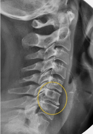 Osteochondrosis krční páteře na x -radě