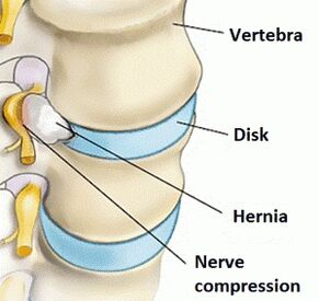 Osteochondroza v oblasti děložního čípku
