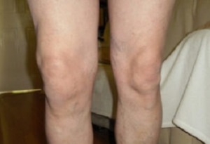 projevy artrózy kolenního kloubu (1)
