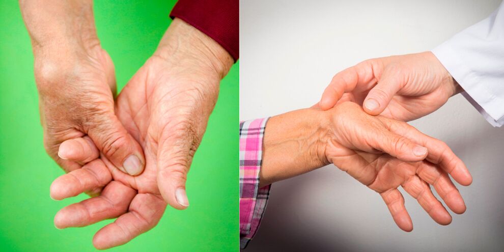 otoky a bolestivé bolesti jsou prvními příznaky artritidy rukou