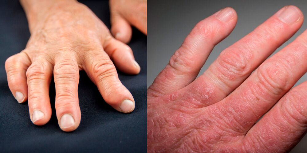 revmatoidní a psoriatická artritida rukou