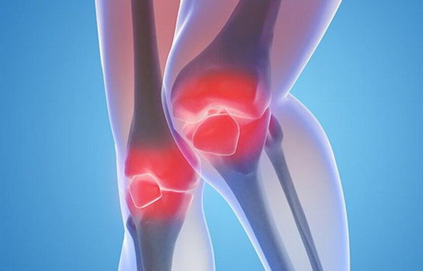 artróza kolenních kloubů