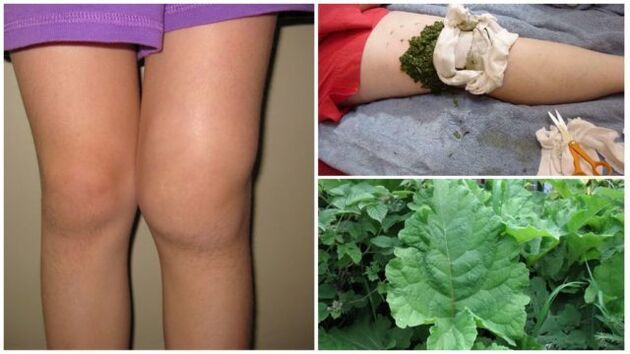 bylinný obklad na osteoartrózu kolene