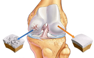 artróza kolenního kloubu